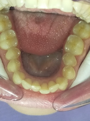 Uzetta-Ortodonzia_anterior_occlusal_mandibular