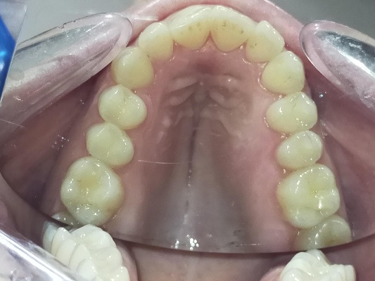 Uzetta-Ortodonzia_anterior_occlusal_maxillary